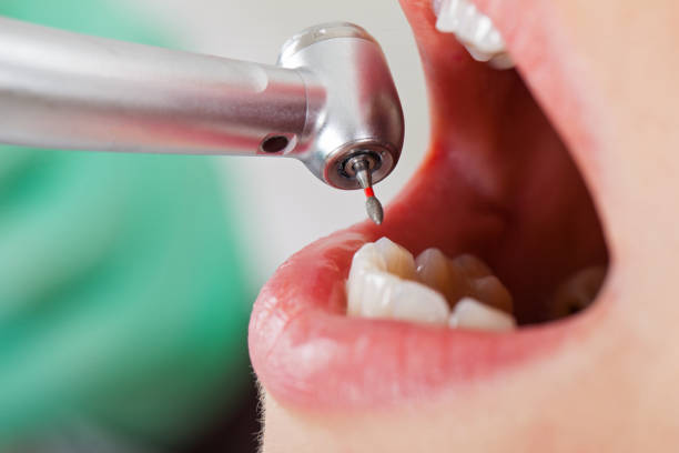 Best Emergency Wisdom Teeth Removal in Wyomissing, PA